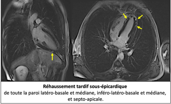 imagerie-cardiaque-cas-clinique-en-direct-de-Lariboisiere-sequence-sequence-de-rehaussement-tartdif-sous-epicardique