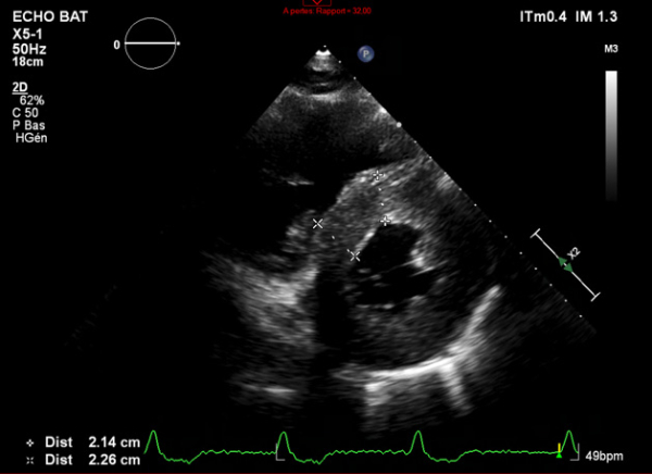Échocardiographie 2D Coupe parasternale petit axe