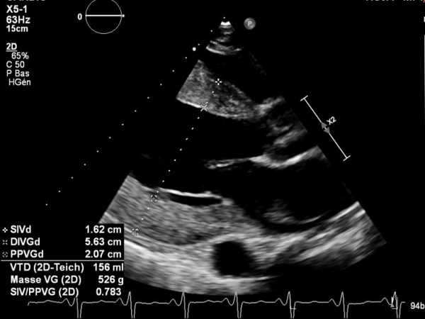 syndrome-oedémateux-figure1