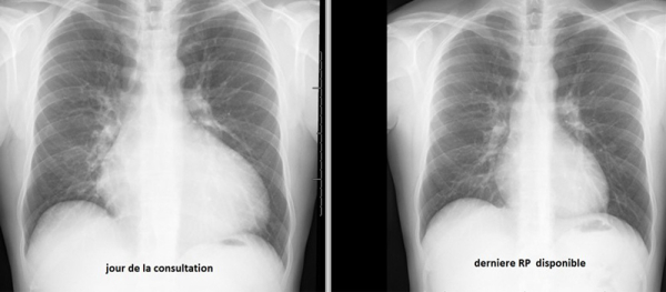 Examens du patient - Radiographie thoracique 
