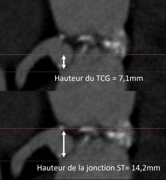Deux-ans-apr&egrave;s-un-TAVI-le-silence-du-sinus-coronaire-gauche-img6.jpg