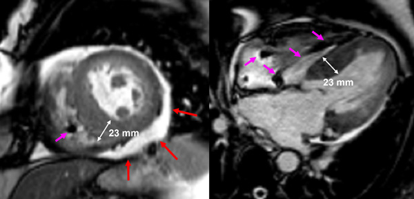 Figure 5 : Séquence Ciné-IRM