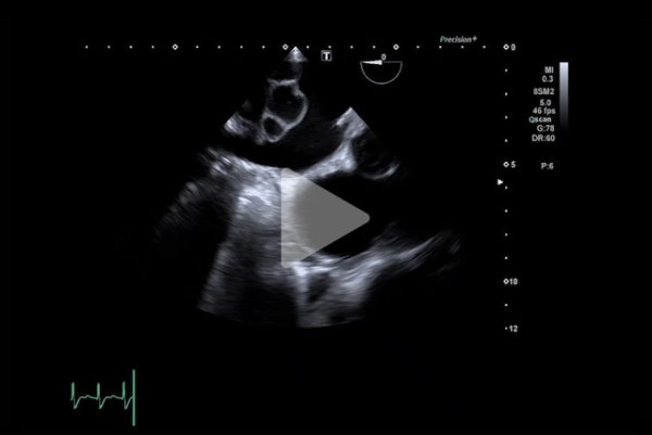 Complication-rare-d-un-remplacement-valvulaire-mitrale-video5-img.jpg