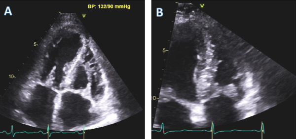 Figure 2. A. Vue 4 cavités montrant l’augmentation d’épaisseur de la valve mitrale et de la valve tricuspide ainsi que la paroi ventriculaire. B. Coupe du ventricule droit montrant l’épaississement important de la valve tricuspide lié à l’infiltration amyloide de l’endocarde.