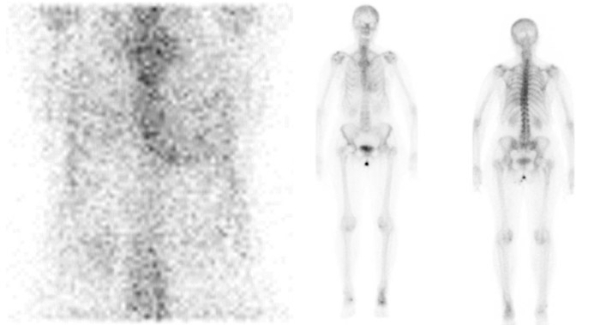 Figure 2 : Scintigraphie corps entiers au DPD aux temps tardifs objectivant une hyperfixation cardiaque sans extinction de la trame osseuse (stade 2 de Perugini)
