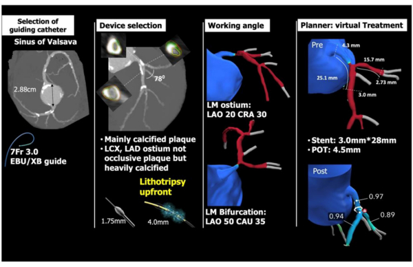 Scanner cardiaque pour la planification d'une intervention coronaire percutan&eacute;e