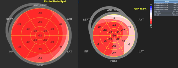Figure 2 : Anomalies du strain longitudinal typiquement abaissé en latéral initialement dans la maladie de Fabry