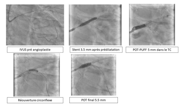 Procédure d’angioplastie du tronc commun vers l’IVA avec provisional stenting