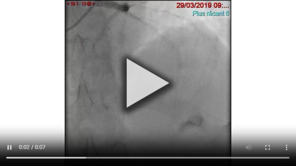 Angiographie post alcoolisation