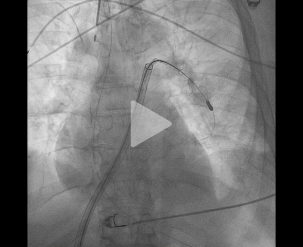 un-infarctus-mais-pas-du-myocarde-vidéo6-img