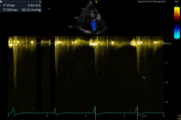 Estimation PAPs sur le flux d’IT en doppler couleur