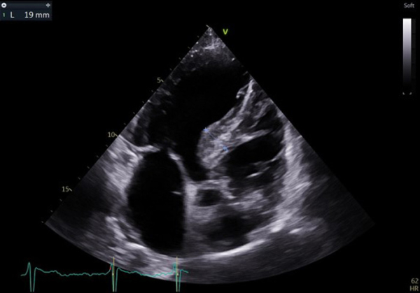 Echographie 