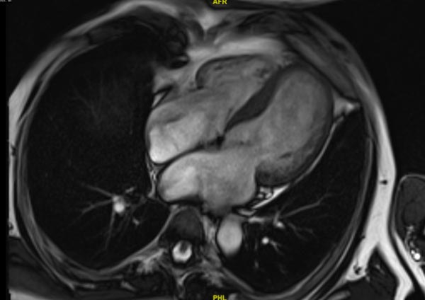 IRM cardiaque