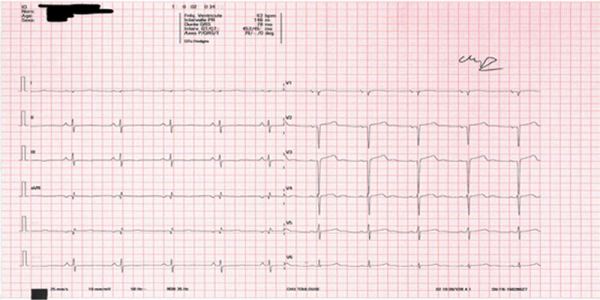 Image 4 du cas clinique "Une amylose AL précoce"