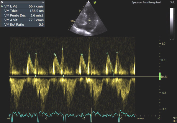 Image 3 : échocardiographie, flux Doppler pulsé transmitral