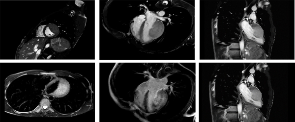 Le syndrome du Caméléon - IRM cardiaque 