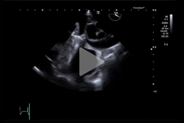 Complication-rare-d-un-remplacement-valvulaire-mitrale-video7-img.jpg