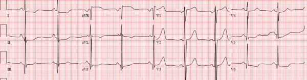 Electrocardiogramme réalisé lors de la consultation