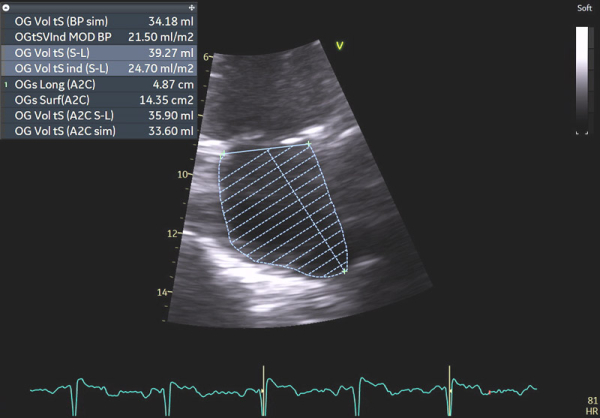 Image 8 : échocardiographie 2D, calcul du volume indexé de l’oreillette gauche (OG)