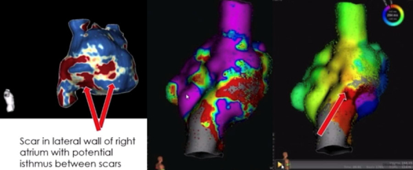 Rôle de l’imagerie dans l’ablation des cardiopathies congénitales