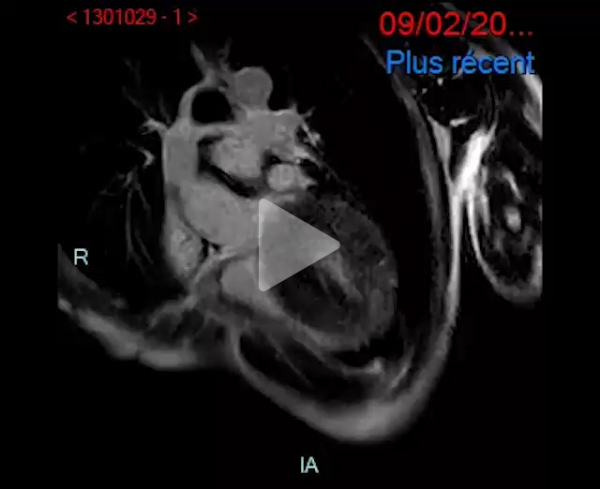 Syndrome_oedémateux_video5_img
