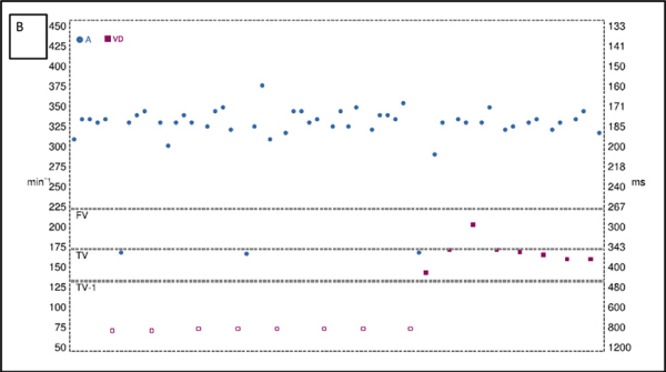 amylose-et-arythmie-figure3