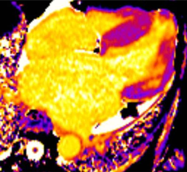 T1 natif légèrement augmenté dans le septum et la paroi latérale (fibrose)