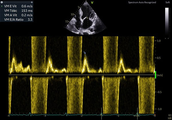 Profil mitral type III restrictif