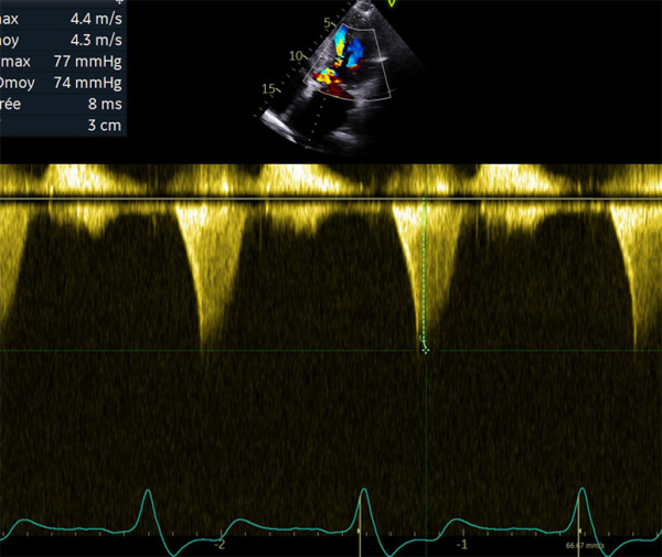 Flux doppler continu trans-aortique d’obstruction