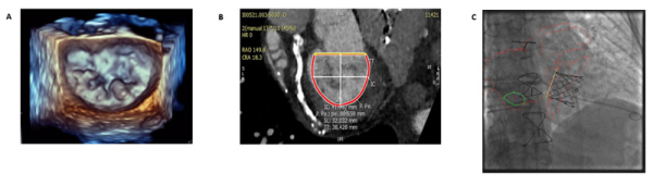 Échocardiographie tridimensionnelle en temps réel