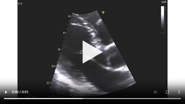 Vidéo 2 : échocardiographie 2D en incidence apicale des 4 cavités