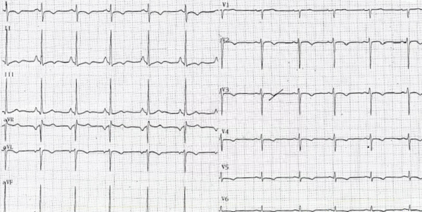 Electrocardiogramme