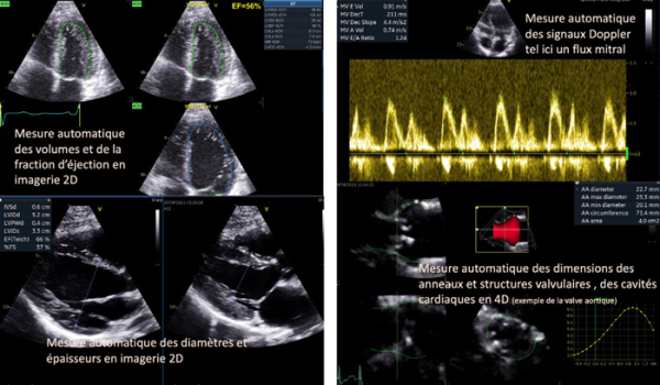 Innovations et perspectives futures de l’intelligence artificielle appliquée à l’échocardiographie - Figure 1