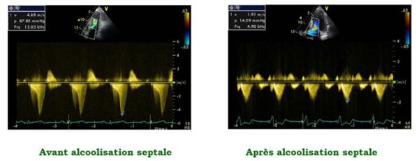 Figure 2 : Régression de l’obstruction intra-ventriculaire gauche mesurée au doppler continu après alcoolisation septale