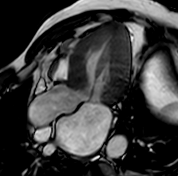 Figure 2 : Ciné-IRM montrant l’insertion directe du muscle papillaire antérieur sur le feuillet mitral antérieur.