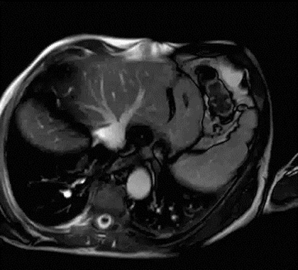 Figure 3 : IRM cardiaque