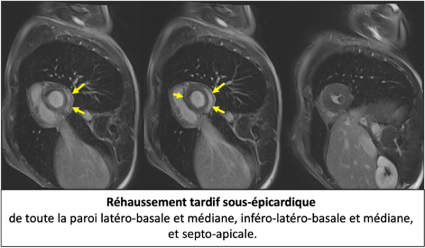 imagerie-cardiaque-cas-clinique-en-direct-de-Lariboisiere-sequence-sequence-de-rehaussement-tartdif