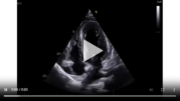 Vidéo 3. Coupe 4 cavités
