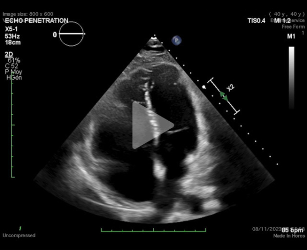 un-infarctus-mais-pas-du-myocarde-vidéo1-img